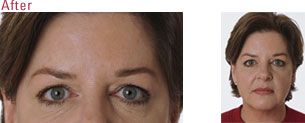 BOTOX Cosmetic Santa Maria
