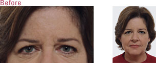 BOTOX Cosmetic Santa Maria