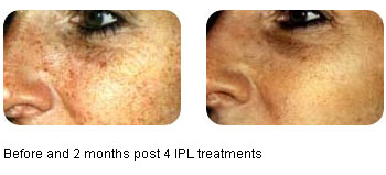 Photorejuvenation Santa Maria, Intense Pulsed Light Santa Maria