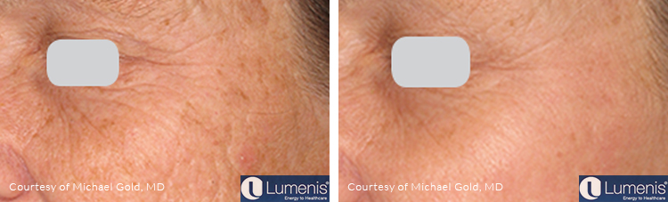 Laser Skin Resurfacing | UltraPulse Treatment Santa Maria CA
