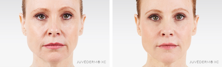 JUVEDERM Santa Maria CA