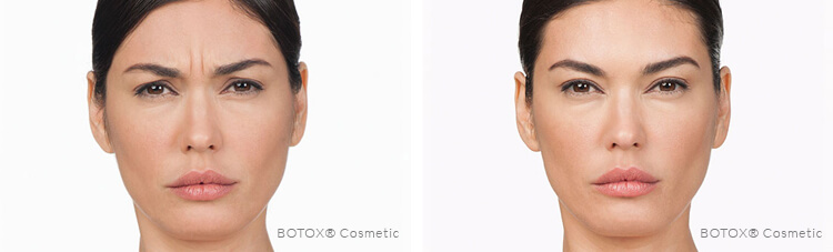 botox