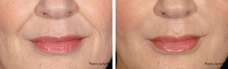Restylane®